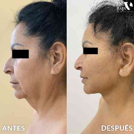 Lifting Facial Mejora La Apariencia Del Rostro Dr Baja