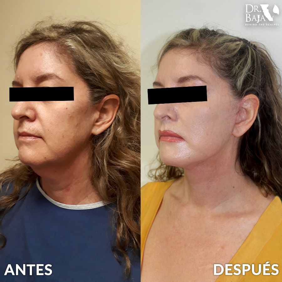 Lifting Facial Rejuvenece La Apariencia Del Rostro Dr Baja