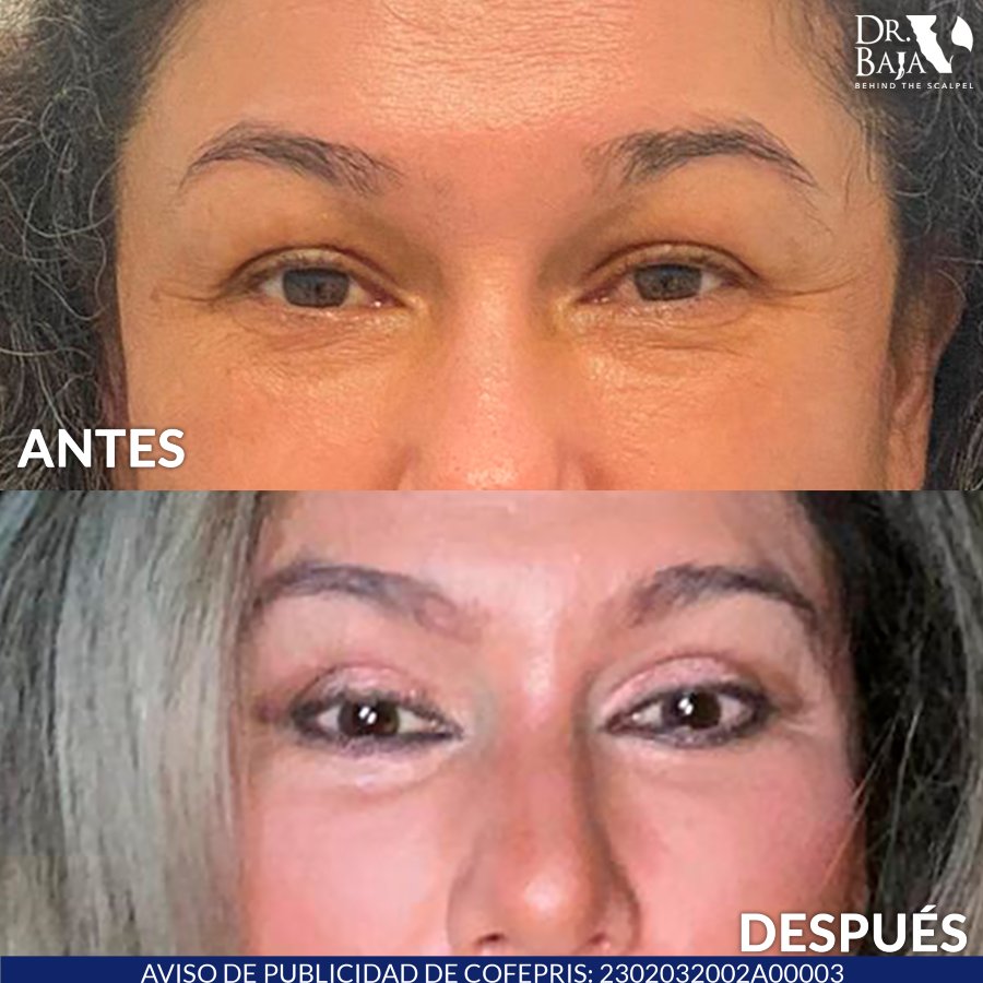 Resultados De Blefaroplastia Dr Baja