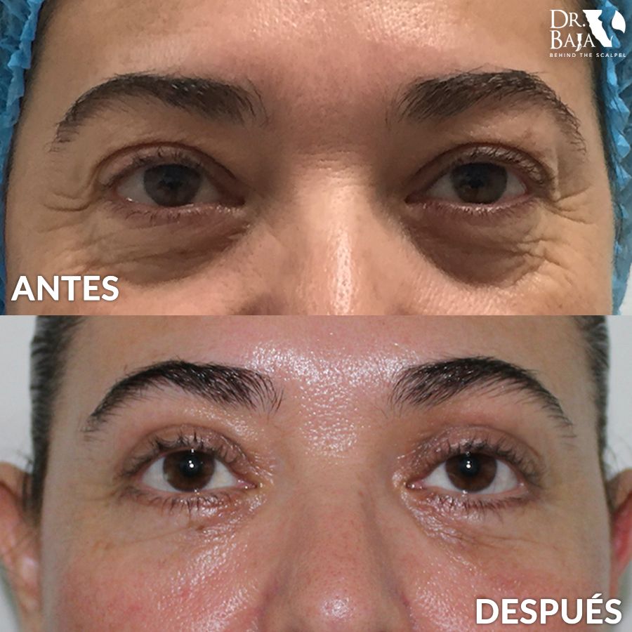 Resultados De Blefaroplastia Dr Baja