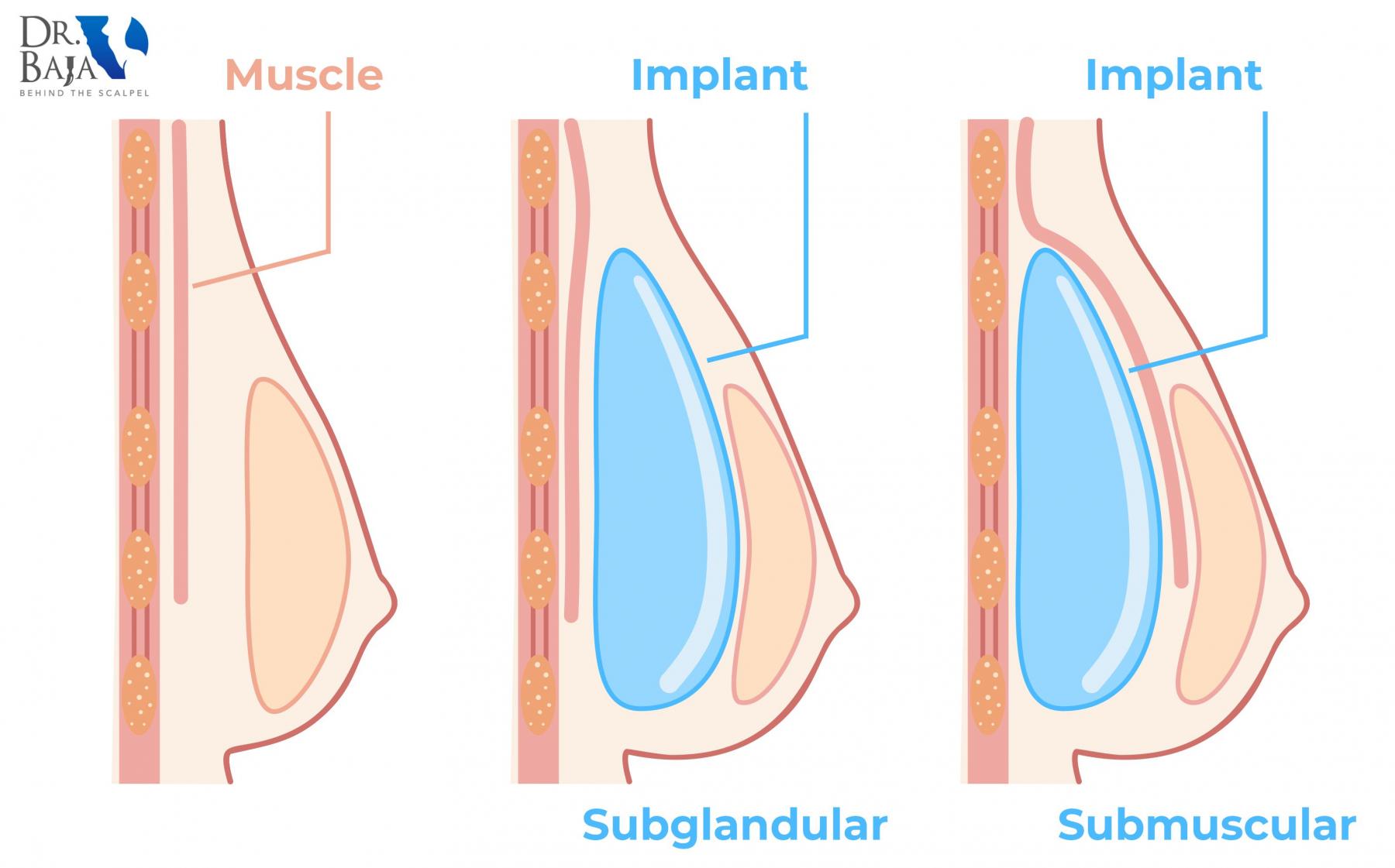 Customize your breast augmentation